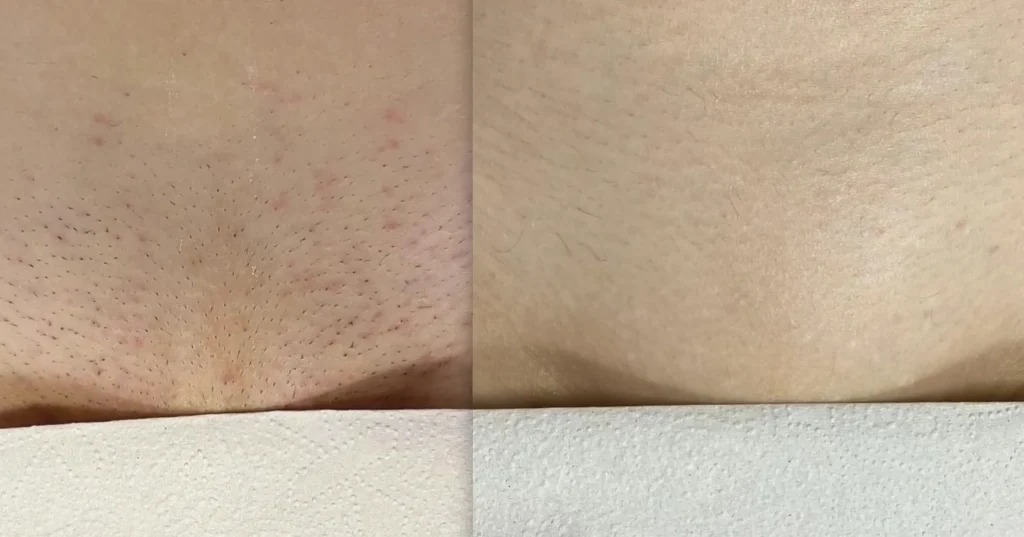 Brazilian laser before and after