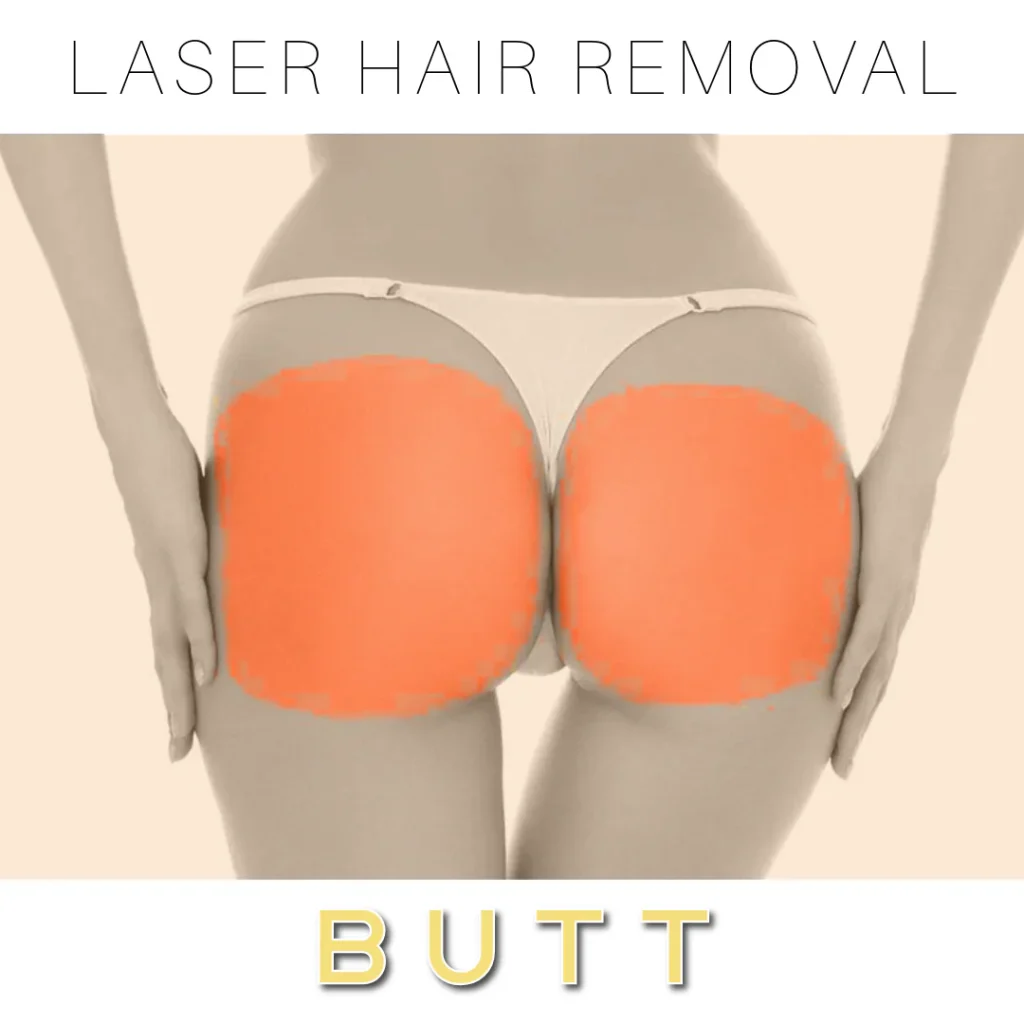 Buttocks Laser Hair Removal Doha