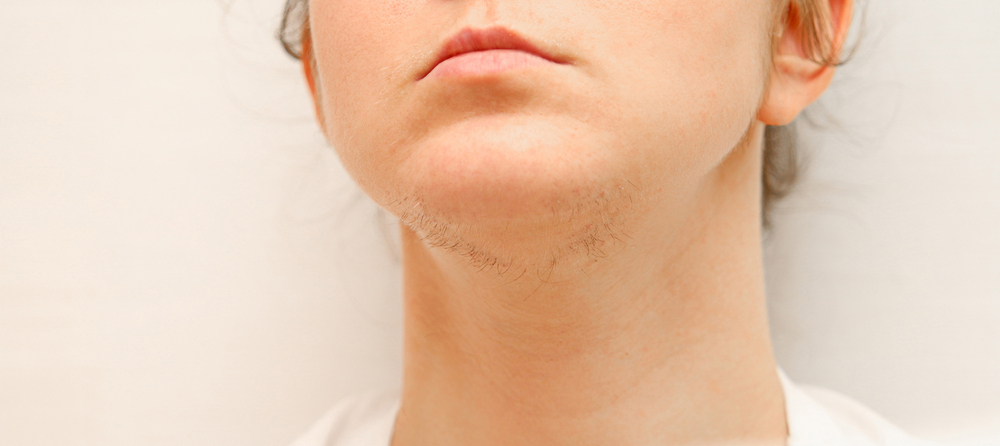 Chest Hair And PCOS