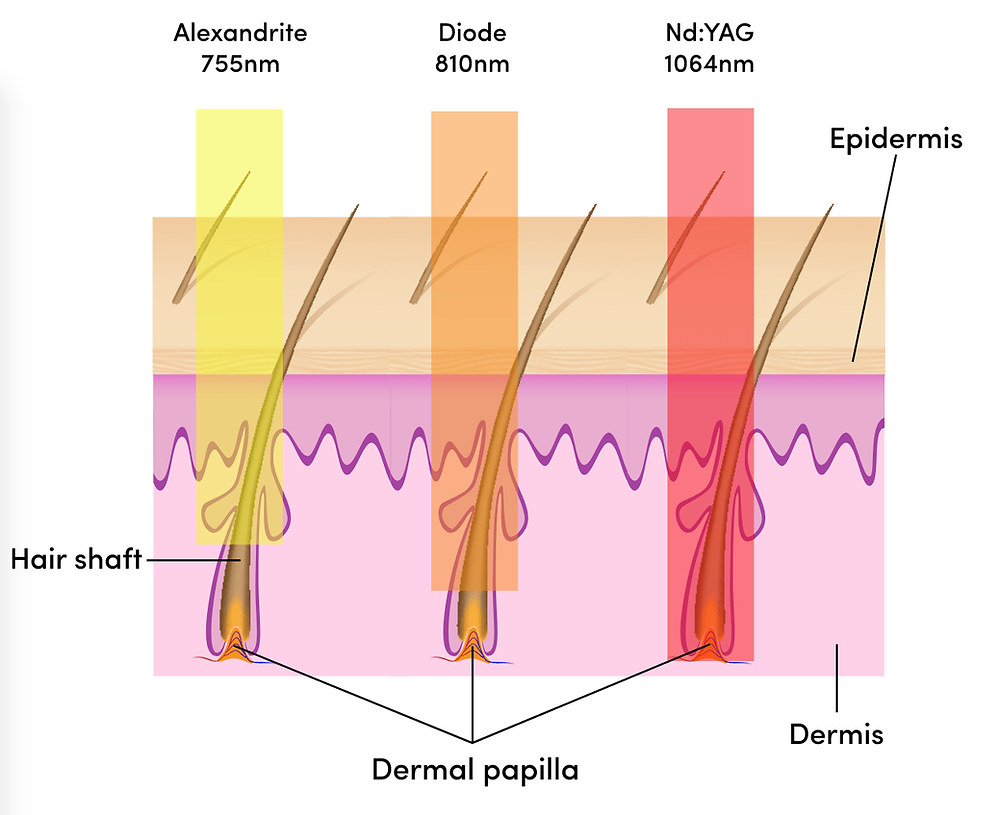 Choosing the Right Laser for Your Skin Treatment