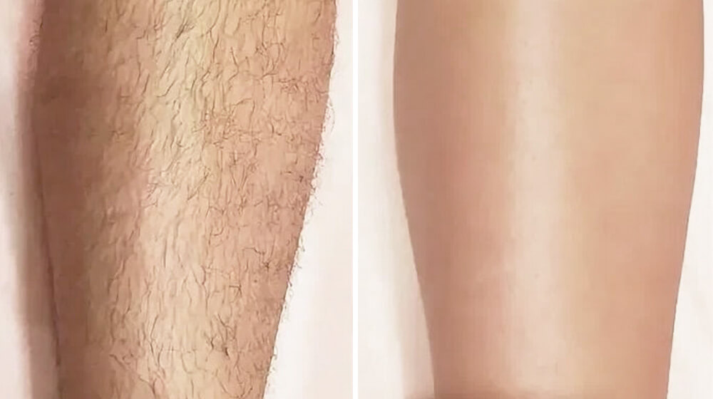 Full Legs Laser Hair Removal Doha