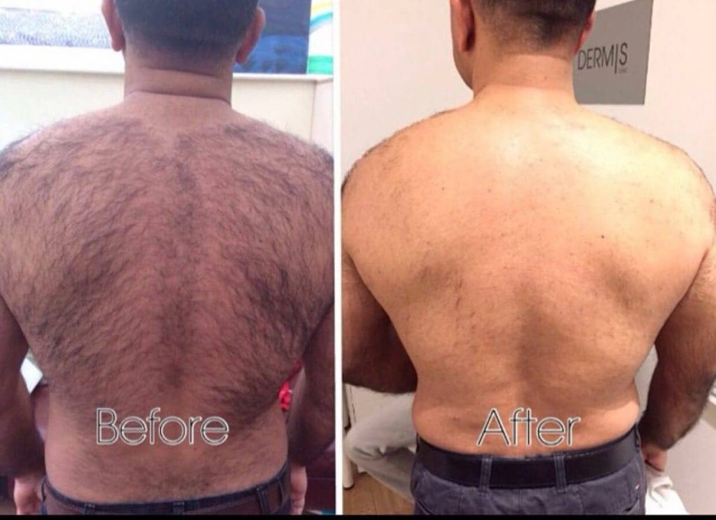 laser hair removal back treatments